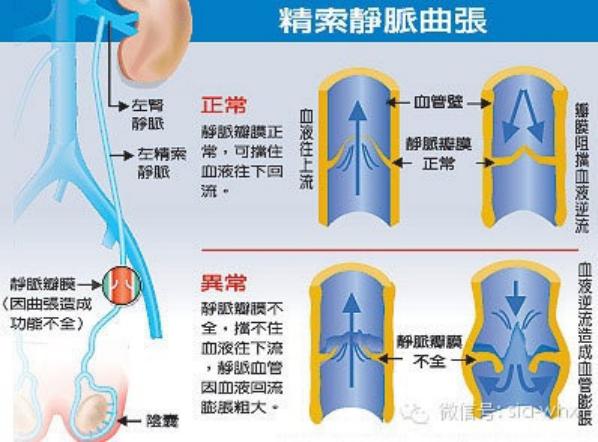 關于2021年征兵精索靜脈曲張標準的探討，2021年征兵精索靜脈曲張標準深度解析