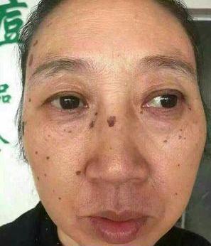 去老年斑的簡單方法，重拾肌膚光彩的秘訣，去老年斑秘籍，重拾肌膚光彩的簡易方法