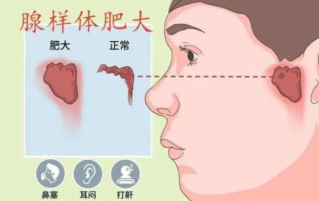 腺樣體肥大能自愈嗎？——深度解析與理解，腺樣體肥大能否自愈？全面深度解析