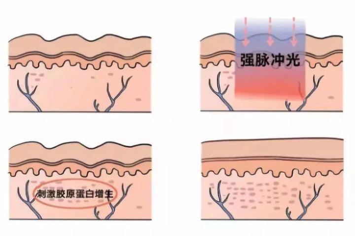 簡單有效的痘坑修復(fù)方法，讓你的肌膚重拾光彩，簡單有效的痘坑修復(fù)秘訣，重塑肌膚光彩！