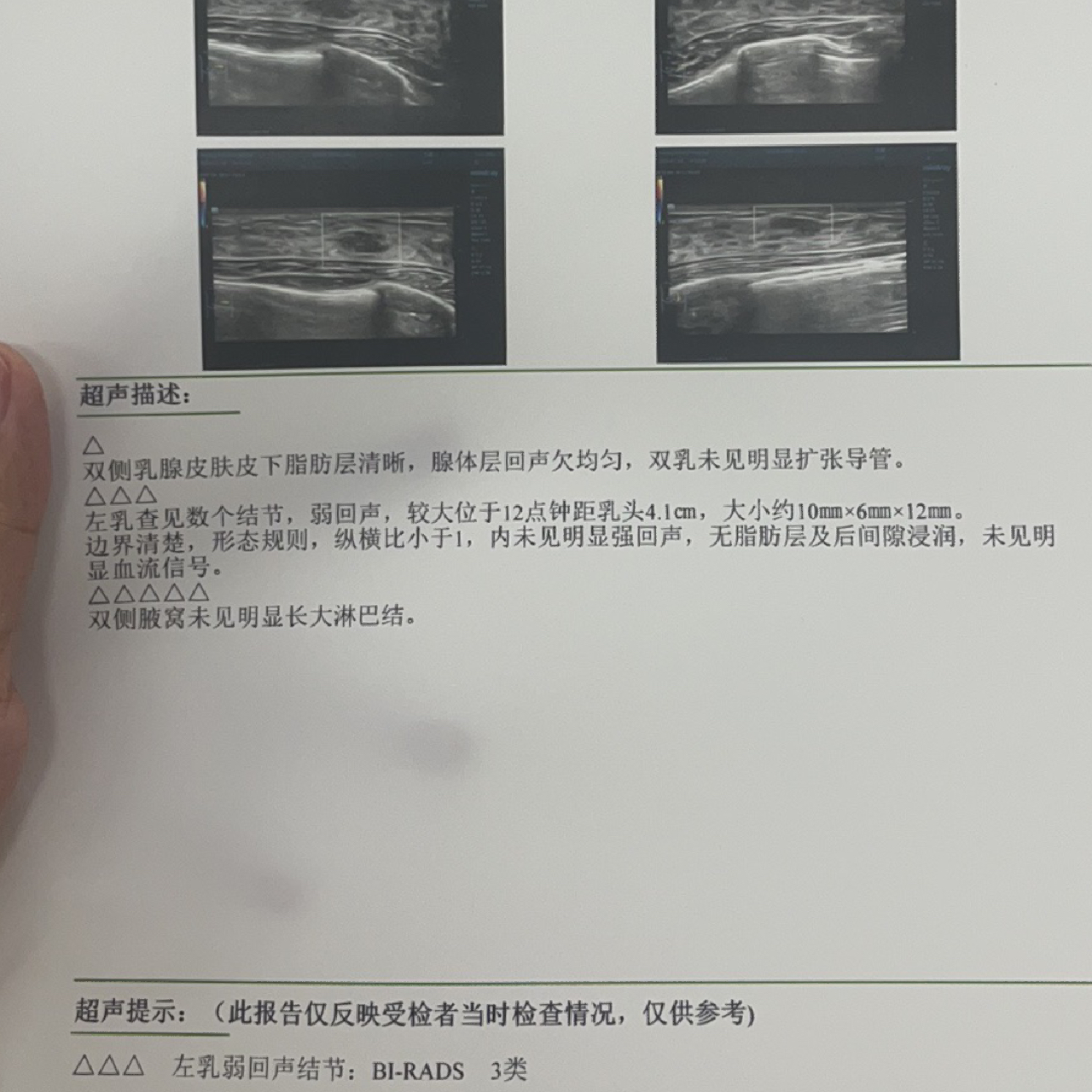 乳腺結(jié)節(jié)3類嚴(yán)重嗎？解讀乳腺健康，讓你了解真相，乳腺結(jié)節(jié)3類嚴(yán)重嗎？解讀乳腺健康真相