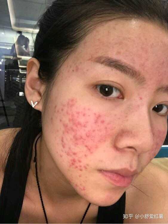 如何有效去除臉上的痘印——全方位指南，全方位指南，如何有效去除臉上痘印的方法