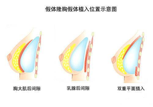 怎么樣才能豐胸最有效最安全，最安全有效的豐胸方法探究