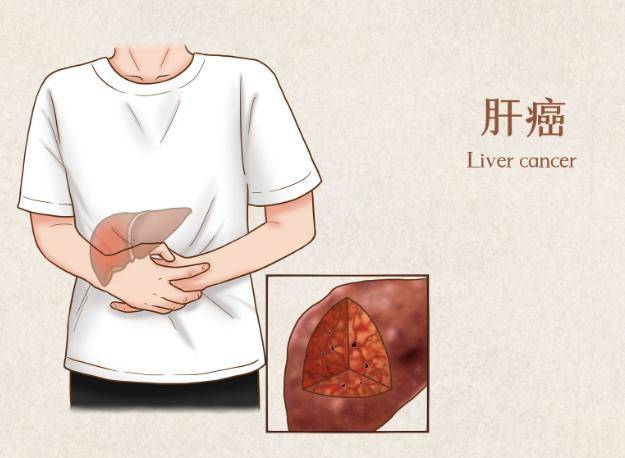肝癌一般三處痛，癥狀解析與應(yīng)對(duì)策略，肝癌癥狀解析，疼痛位置、應(yīng)對(duì)策略及三處痛詳解