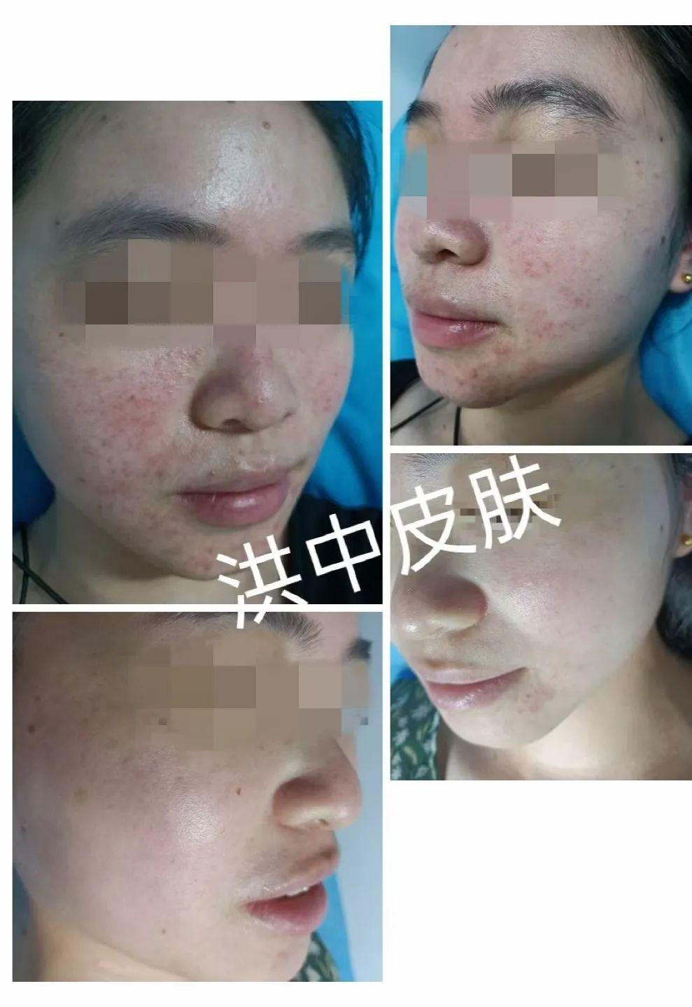 痤瘡圖片的樣子，深入了解痤瘡癥狀與表現(xiàn)，痤瘡癥狀深度解析，圖片展示痤瘡表現(xiàn)與形態(tài)